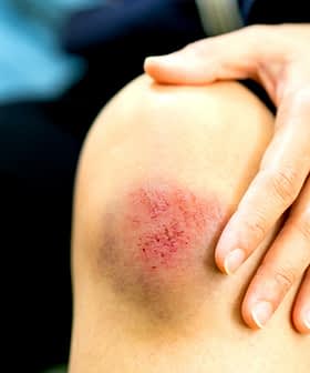 Close-up of a person's knee showing a bruise and scrape with a hand resting on it. - Olive Oil Times